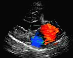 異常心エコー像